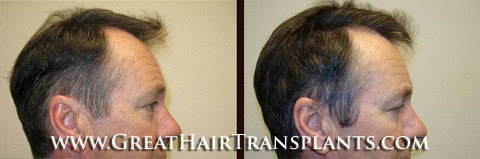 low cost hair transplants