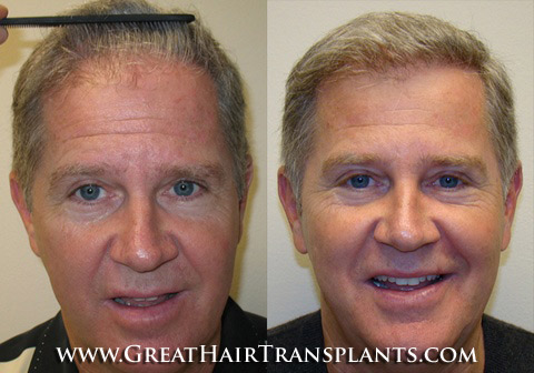 hair surgeons