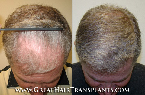 affordable hair transplants