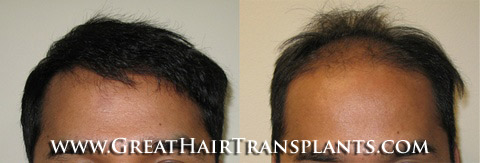 hair transplants