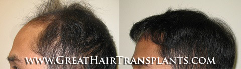 hair transplant