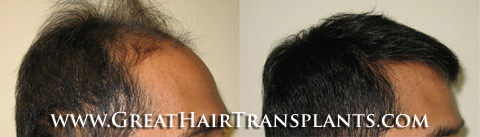 hair transplants cost