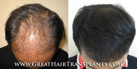 hair restoration