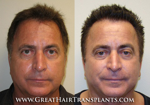 hair restoration