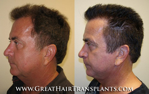 hair transplant