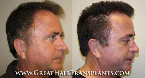 hair restoration