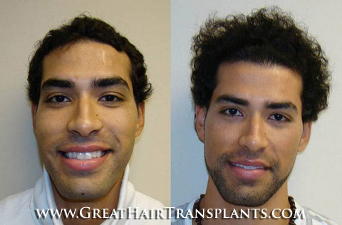 hair implants