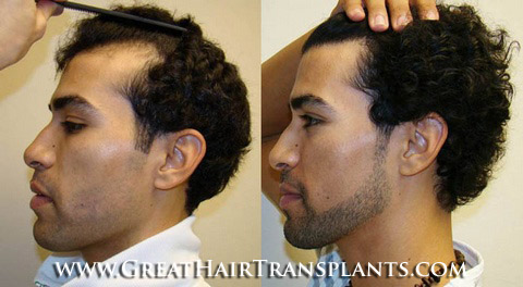 hair transplants