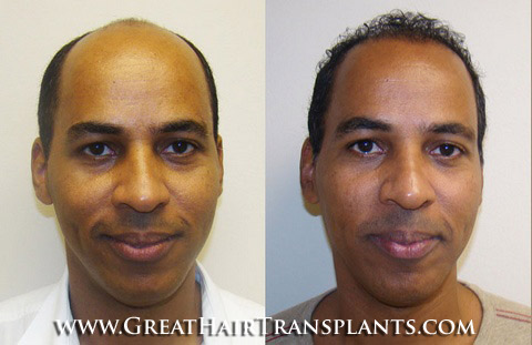 hair restoration