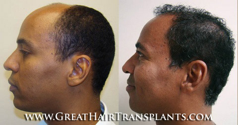 hair transplant cost