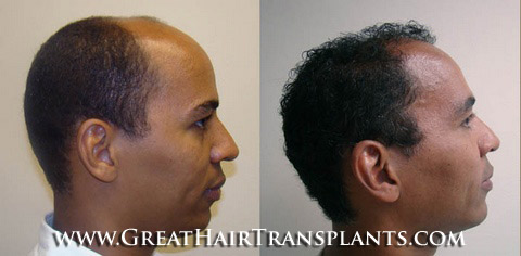 hair restoration