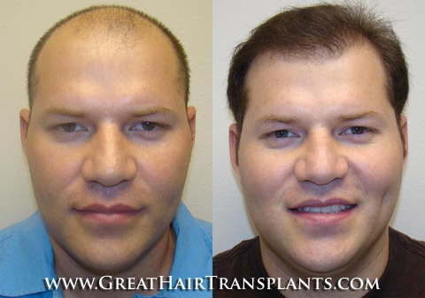 hair restoration