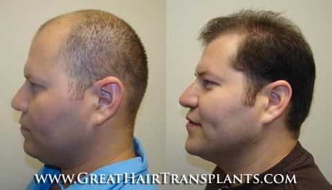 hair transplants