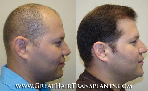 hair transplant