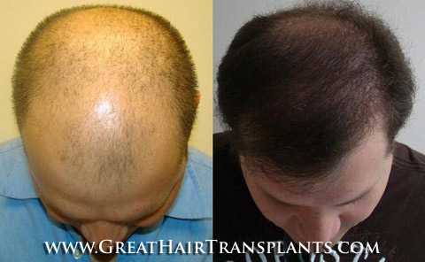 hair transplant