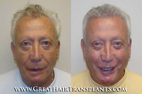 hair transplant surgery