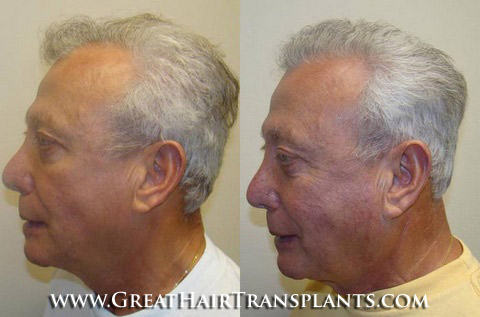 hair transplant