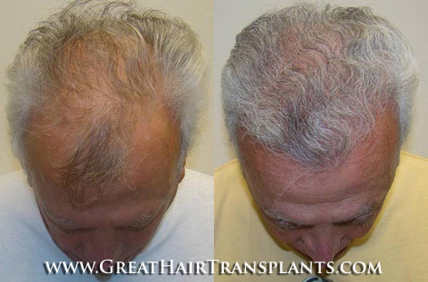 affordable hair transplants