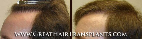 low cost hair transplants