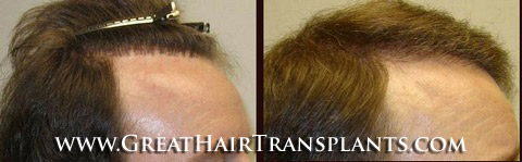 low cost hair transplants