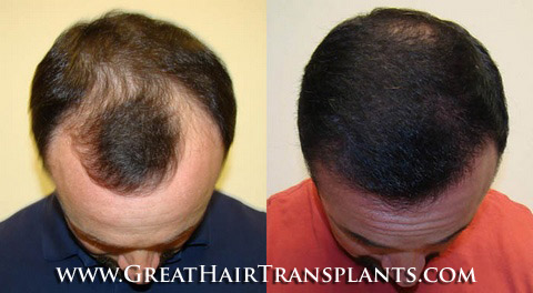 hair transplants cost