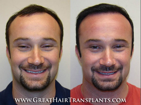 hair transplant