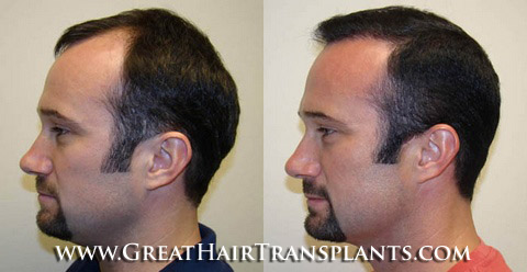 hair transplant cost