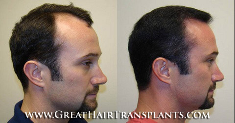 low cost hair transplants