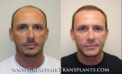 hair transplant surgery