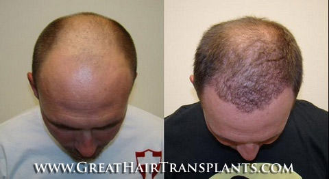 hair restoration