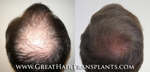 hair transplants