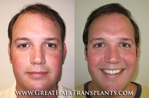 low cost hair transplant