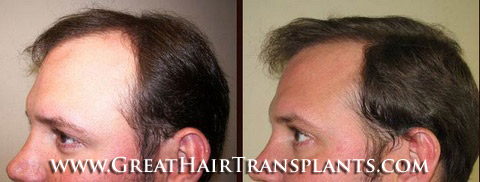 hair transplant cost