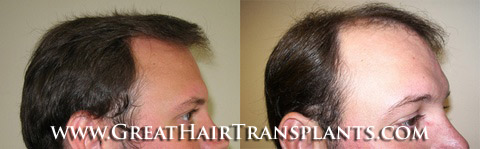 hair transplant