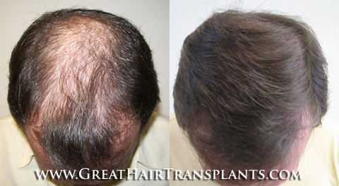 hair transplant