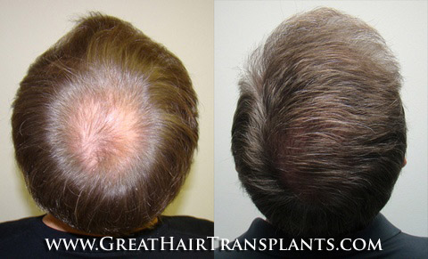 affordable hair transplants