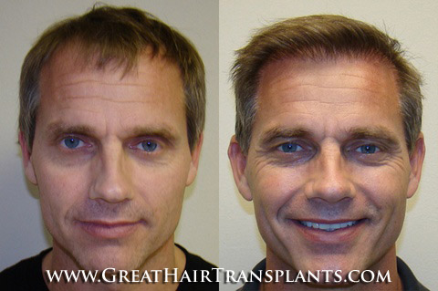 hair transplant cost