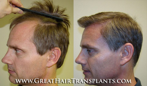 hair restoration