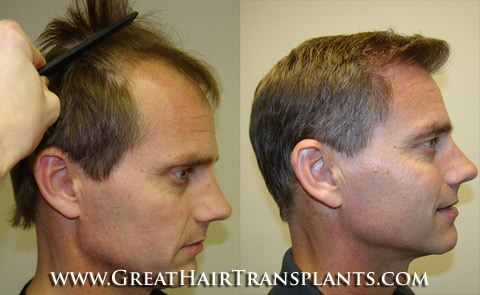 hair transplant surgery