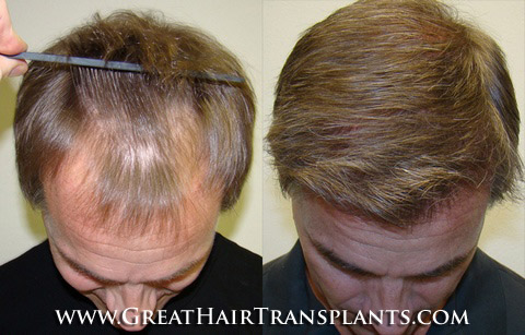 hair transplant