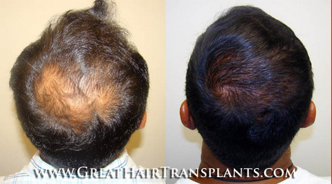 hair restoration