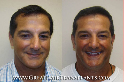 hair transplant cost