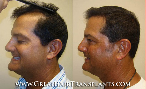 hair transplant cost