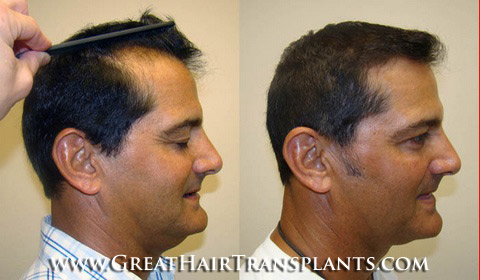 low cost hair transplant