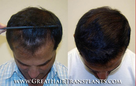 hair transplant cost