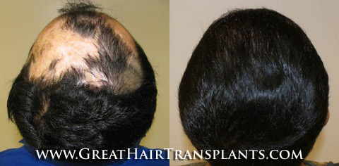 hair transplant cost