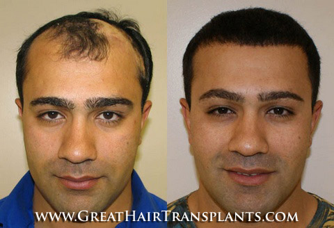 hair transplants