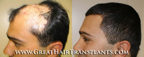 hair transplants cost