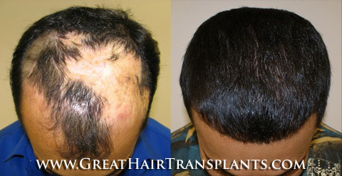 hair transplants cost