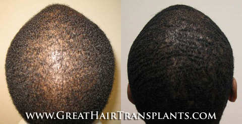 affordable hair transplants